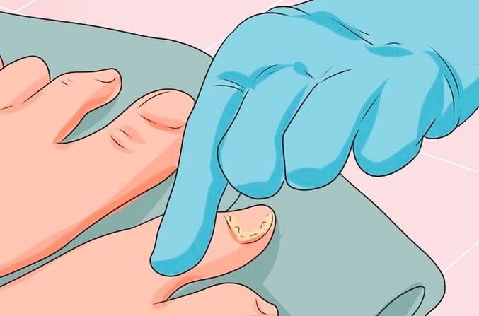 Die ersten Anzeichen einer Nagelmykose