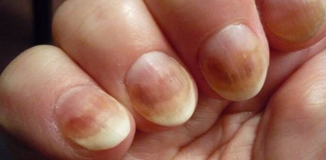 Infektion mit Nagelmykose