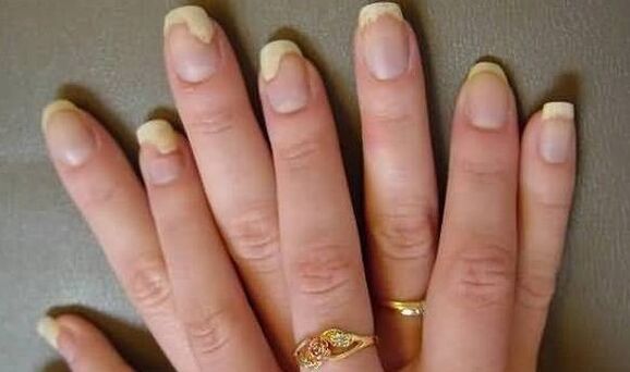 So ist der Nagelpilz in der Verschlimmerungsstufe zu sehen