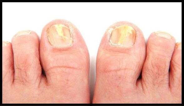 Nagelpilz