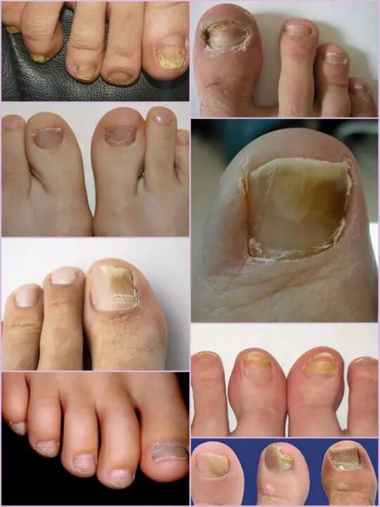 Nagelpilzsorten